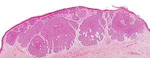 basal-cell-carcinoma